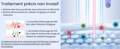NailPulse : Dispositif IR pour traitement fongique des ongles, Elimination de L'onychomycose, Charge USB, Lumière Infrarouge 905Nm (destruction fongique) , Lumière Bleue (désinfection) 470Nm