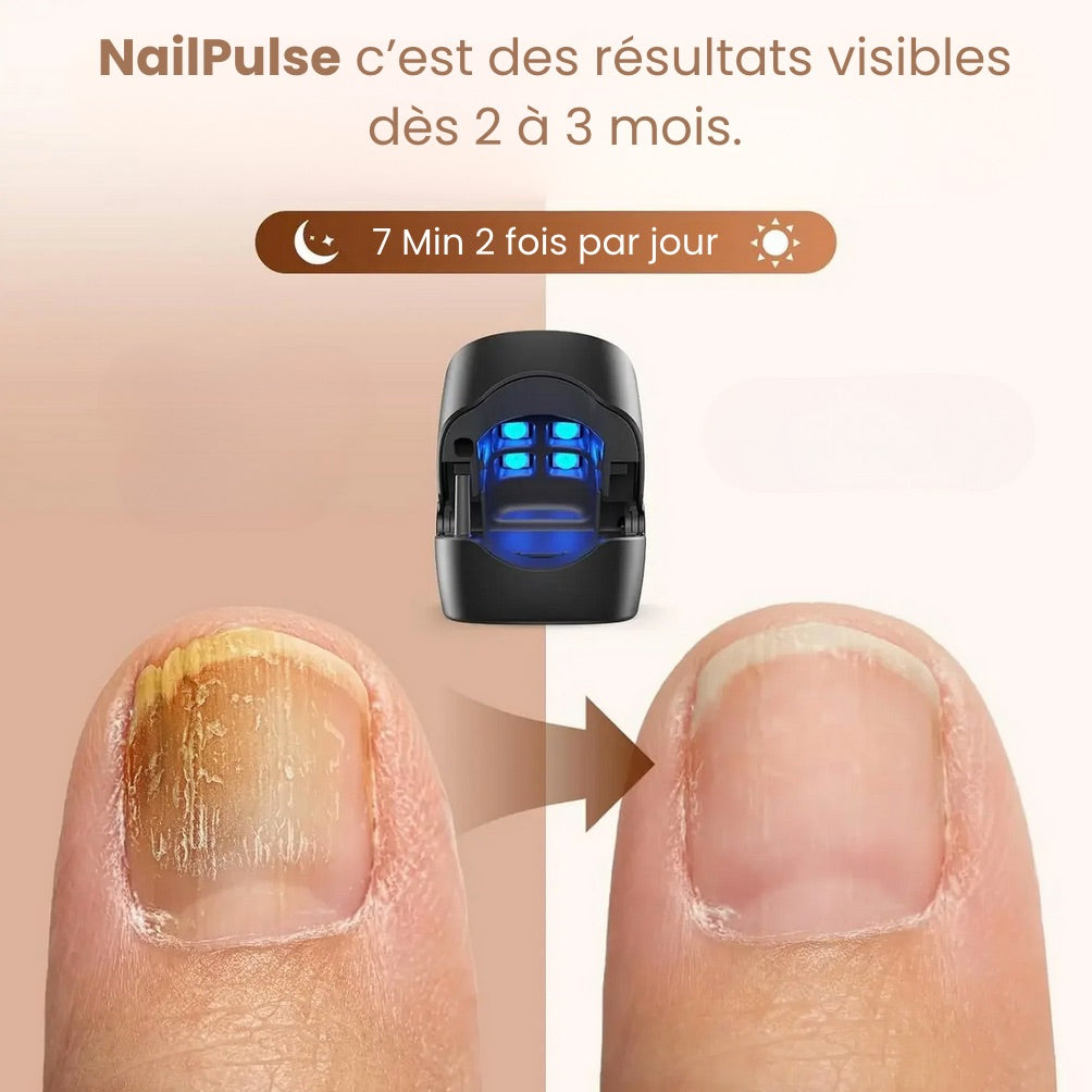 NailPulse : Dispositif IR pour traitement fongique des ongles, Elimination de L'onychomycose, Charge USB, Lumière Infrarouge 905Nm (destruction fongique) , Lumière Bleue (désinfection) 470Nm
