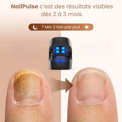 NailPulse : Dispositif IR pour traitement fongique des ongles, Elimination de L'onychomycose, Charge USB, Lumière Infrarouge 905Nm (destruction fongique) , Lumière Bleue (désinfection) 470Nm