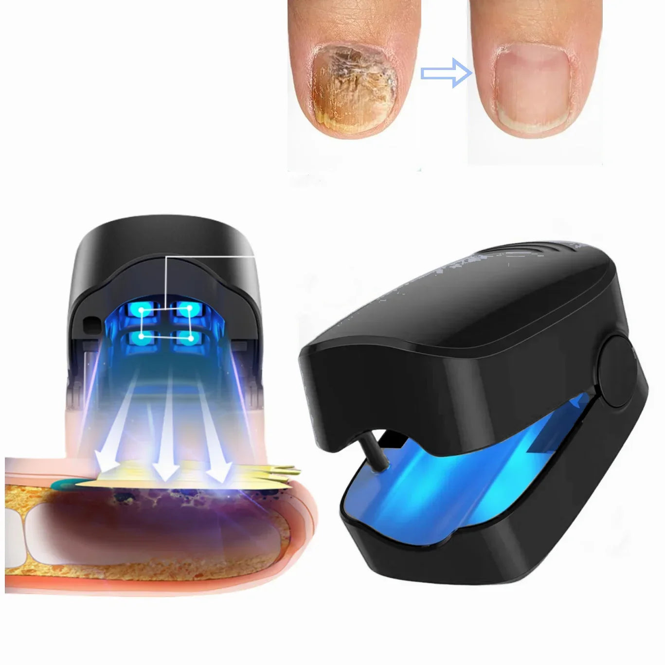 NailPulse : Dispositif LED IR pour traitement fongique des ongles, Elimination de L'onychomycose, Charge USB, Lumière Infrarouge 905Nm, Lumière Bleue 470Nm
